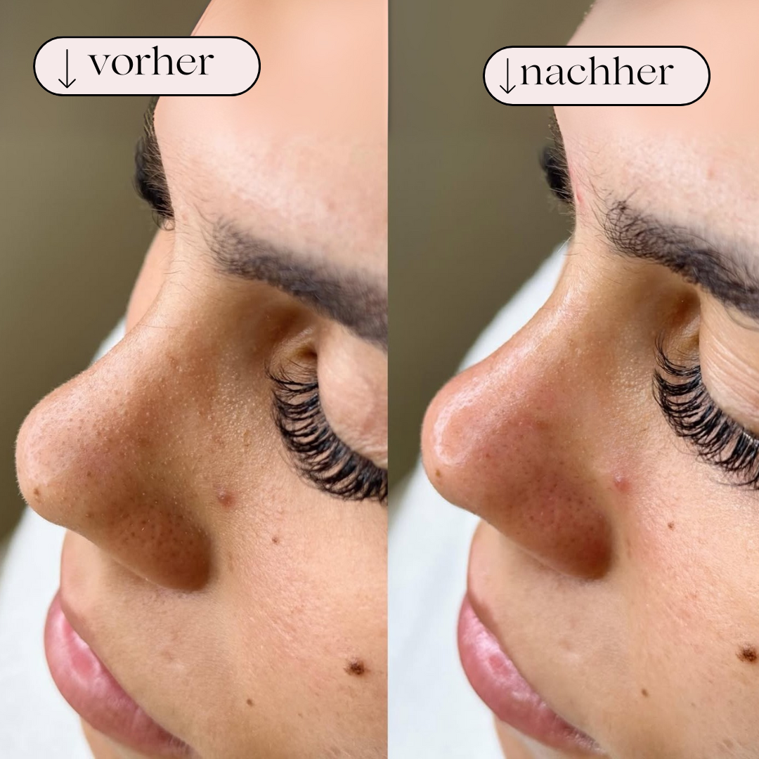Hydrodermabrasion Porenreiniger – Wasserstoff- und Sauerstoffreinigung